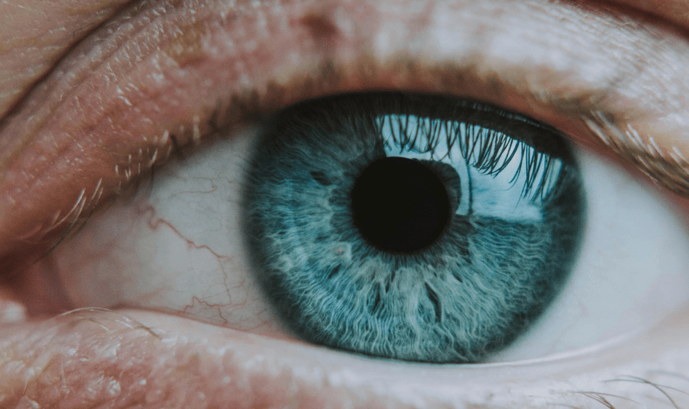 What Is Commonly Misdiagnosed As Pink Eye